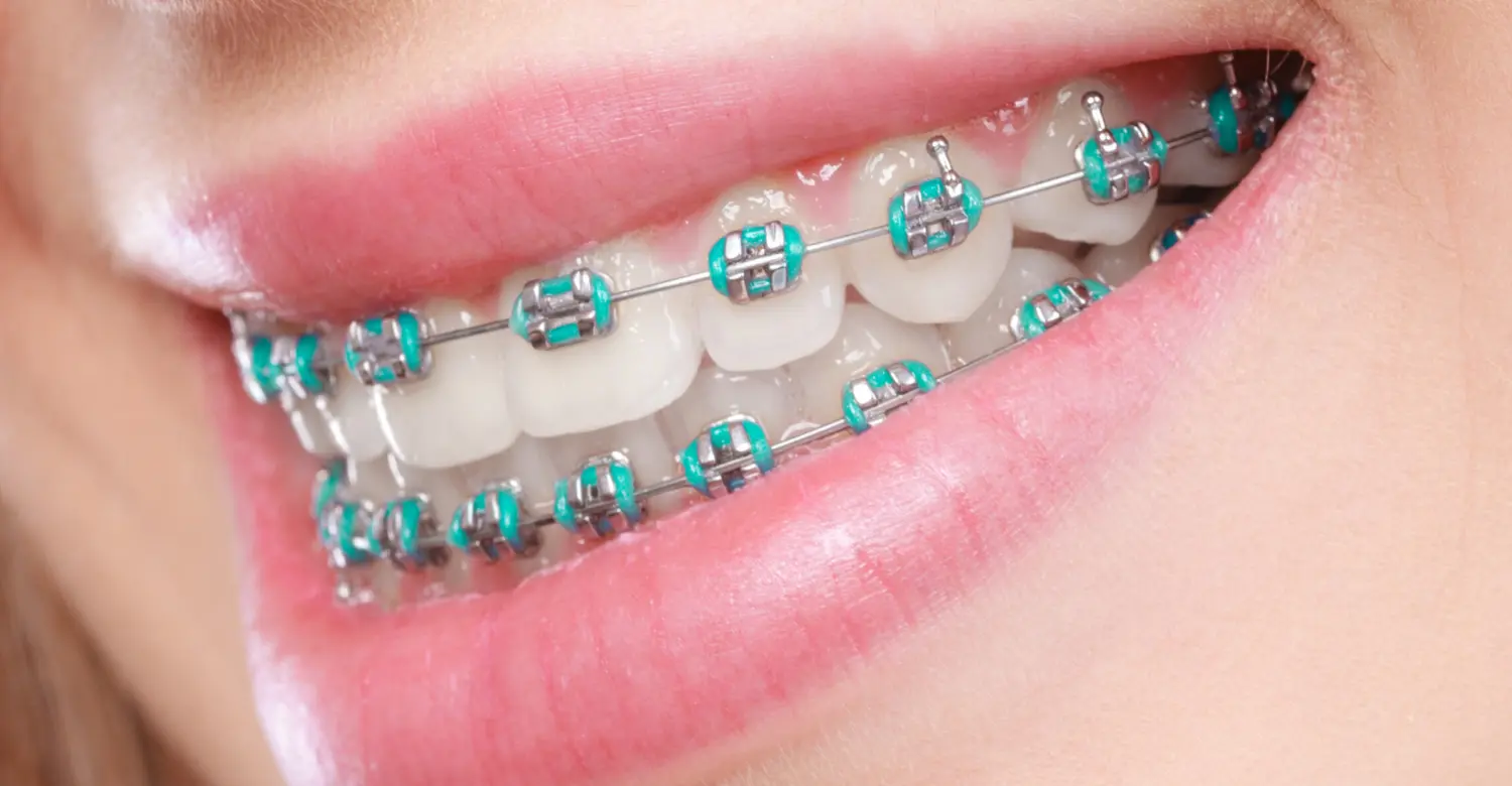 how much are orthodontics 2